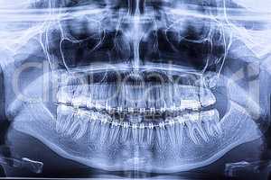 Dental radiography with braces