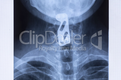 Radiography of titanium plate to support the cervical spine