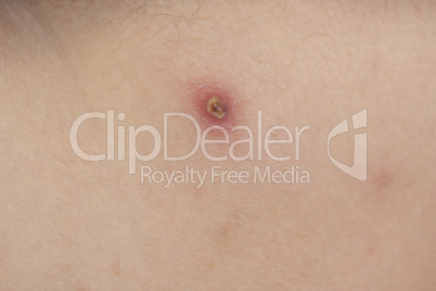 Big red boiling pimple furuncle on the skin, inflamed boil, dermatology photo
