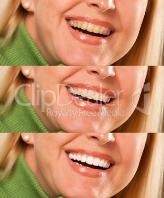 Smiling female showing progressive teeth whitening and bleaching