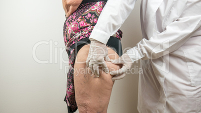 surgeon doing a medical check up by palpating the buttock, on adipose tissues, cellulite, on a female patient with, seen from the side profile