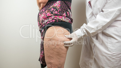 surgeon doing a medical check up by palpating the buttock, on adipose tissues, cellulite, on a female patient with, seen from the side profile