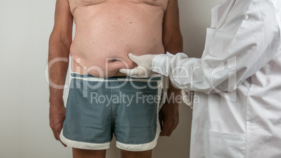 surgeon doing a medical checkup by palpating the belly on adipose tissues, cellulite, on a man patient with a flacid belly, seen from the front