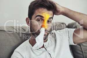 Looks like its flu season again. Portrait of a unhappy young man wearing a tissue in his nose due to sinus related problems.