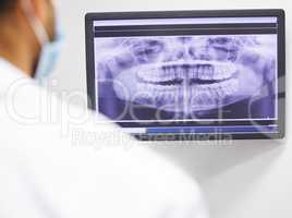 Looks like well have to do an extraction. a dentist analysing an x ray of a patients teeth.